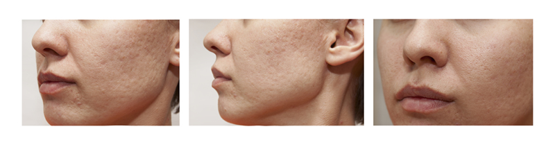 1 Week of using Joyal Beauty Age Defy Serum